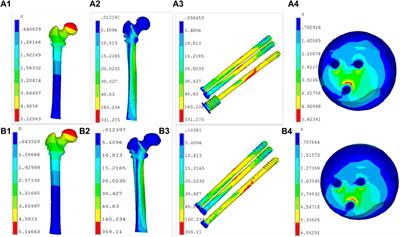 Biomechanical analysis of a new cannulated screw for unstable femoral neck fractures